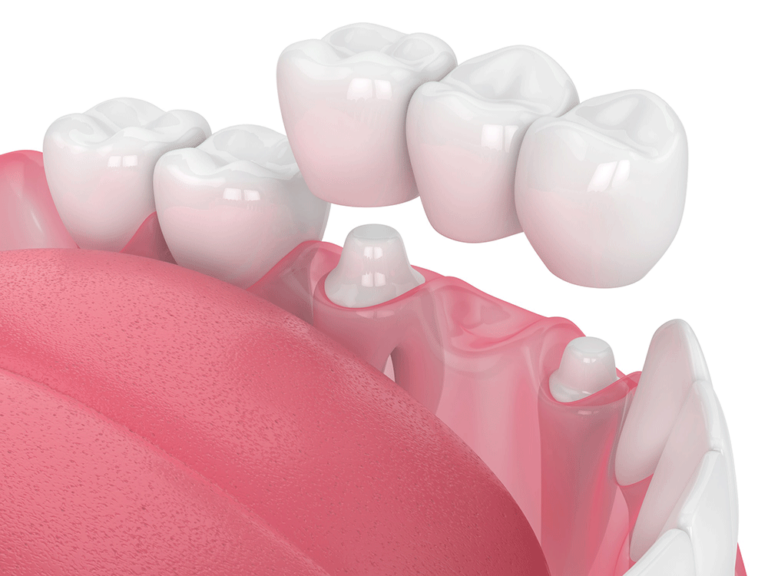 Dental crowns and bridges in Tucson, AZ at Tucson Dental Studio