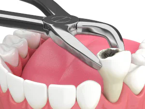 About tooth extractions in Tucson, AZ, at Tucson Dental Studio