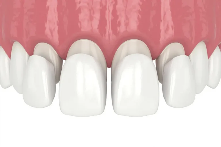 Illustration of Dental Veneers in Tucson, AZ
